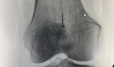 Алматинка десятки лет ходила с иголкой в колене