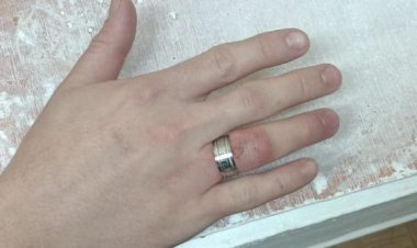 Болгаркой срезали кольцо с пальца жителя Экибастуза