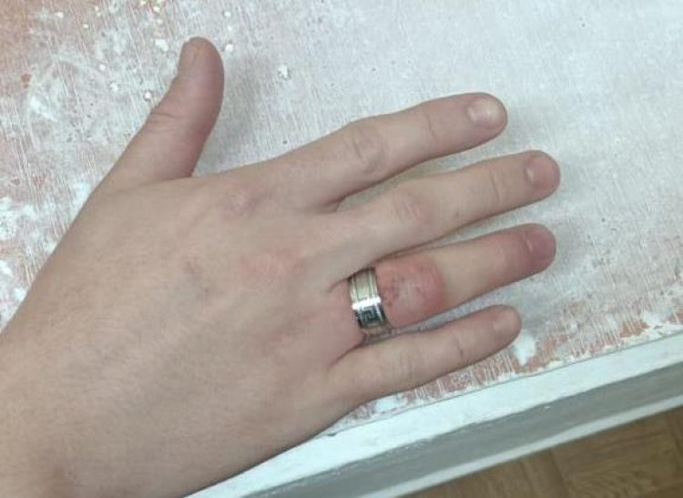 Болгаркой срезали кольцо с пальца жителя Экибастуза