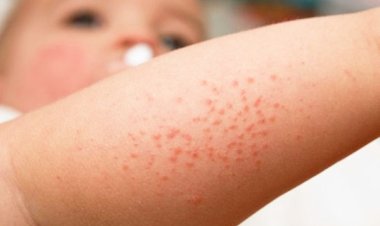 В Павлодарской области стали меньше болеть скарлатиной