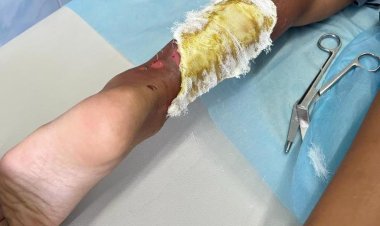 Кипяток и суп: как павлодарцам помочь детям при ожогах