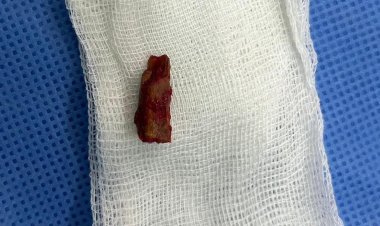 Павлодарские доктора вытащили инородное тело из виска мальчика